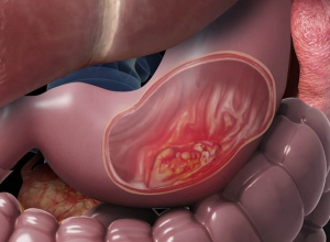 Ung thư dạ dày sống được bao lâu theo từng giai đoạn bệnh?